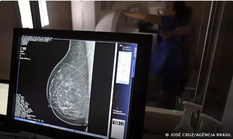 Periodicidade de mamografias divide médicos e autoridades de saúde
